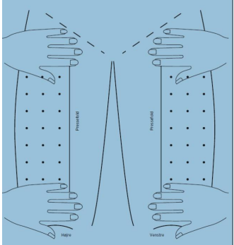Injektioner i låret gives i et område svarende til fra pressefold til sidesøm, en håndsbredde over knæet og håndsbredde under lysken.